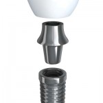 Tooth implant